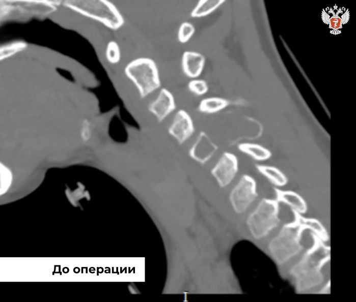 Хирурги НМИЦ травматологии и ортопедии им. Н.Н. Приорова Минздрава России удалили 12-летнему мальчику кисту с применением технологий 3D-печати