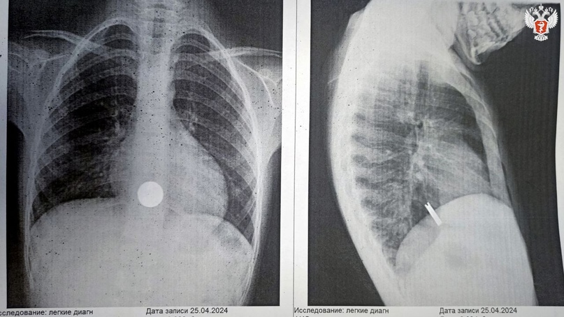 Алтайские врачи провели операцию 7-летнему мальчику с застрявшими в пищеводе монетами