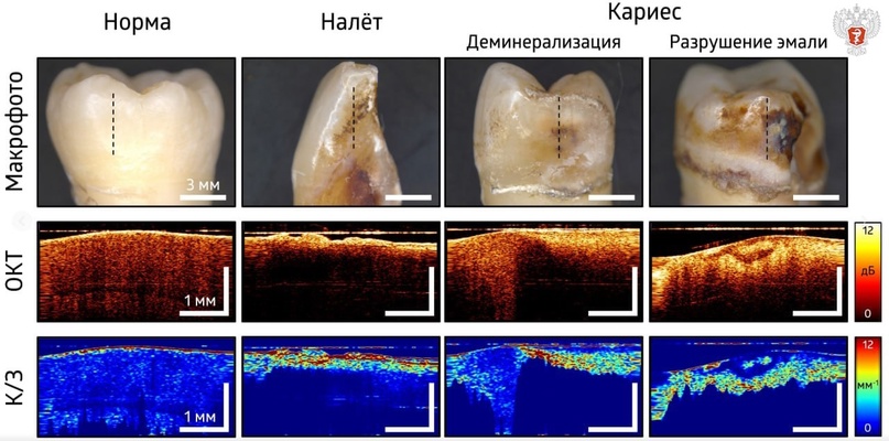 Специалисты ПИМУ Минздрава России разработали новую методику ранней диагностики кариеса