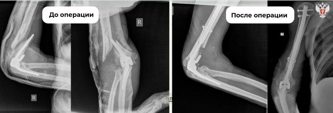Специалисты НМИЦ травматологии и ортопедии им. Илизарова Минздрава России провели уникальное лечение сложного перелома плеча
