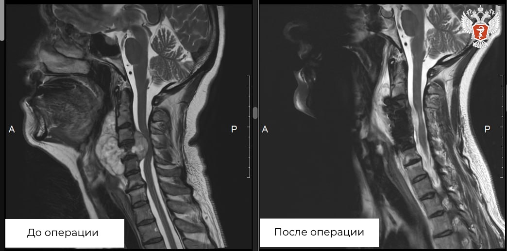 «Три месяца я не могла двигаться»: Новосибирские нейрохирурги удалили опасно сдавившую спинной мозг пациентки опухоль