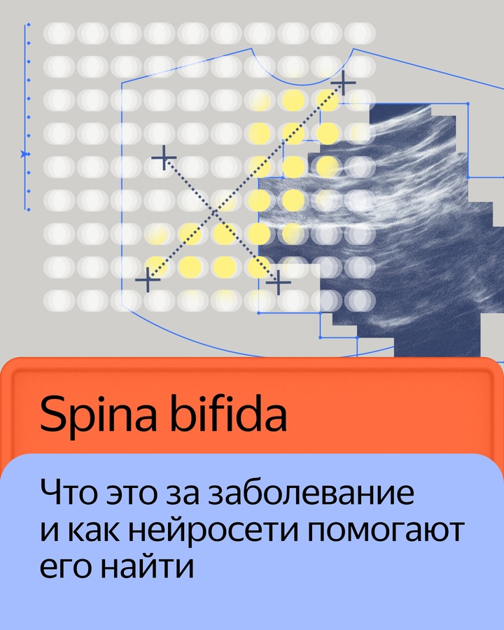 Нейросеть Яндекса поможет врачам выявлять признаки редкого заболевания spina bifida на ранних сроках беременности
