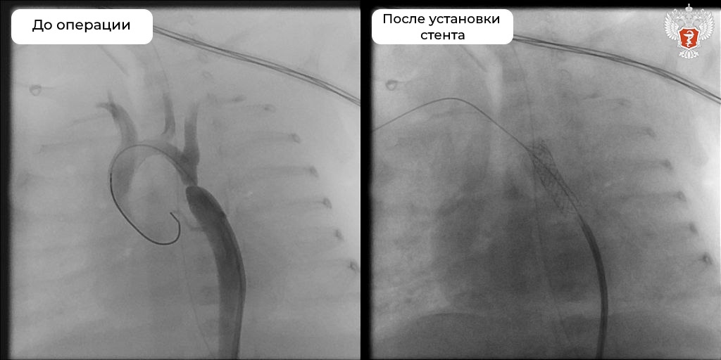 Врачи Хабаровского ФЦССХ Минздрава России прооперировали тяжелый порок сердца у недоношенного малыша с крайне низким весом