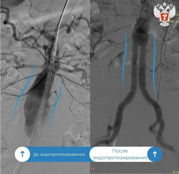 Нижневартовские хирурги провели первые операции эндопротезирования брюшной аорты