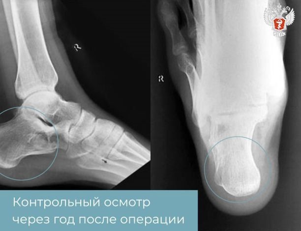 Врачи НМИЦ травматологии и ортопедии имени Г.А. Илизарова Минздрава России предотвратили травму у юного спортсмена с кистой в стопе