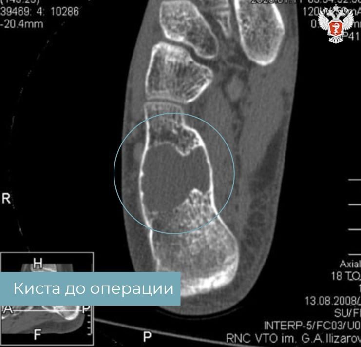 Врачи НМИЦ травматологии и ортопедии имени Г.А. Илизарова Минздрава России предотвратили травму у юного спортсмена с кистой в стопе