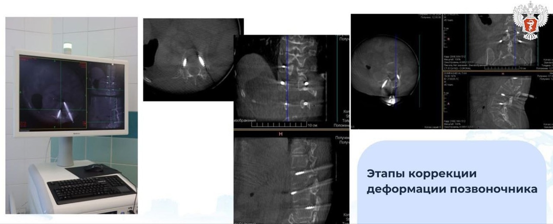 Врачи НМИЦ травматологии и ортопедии имени Г.А. Илизарова Минздрава России с помощью раздвижного имплантата исправили деформацию позвоночника