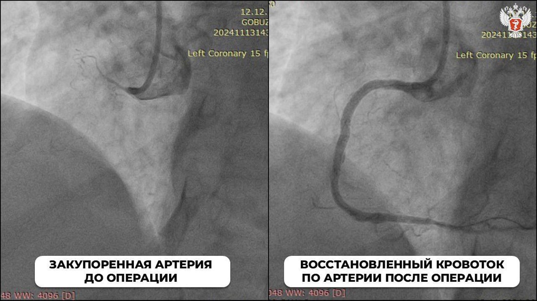 Жительницу Старой Руссы Новгородской области с инфарктом спасли с помощью высокотехнологичной операции