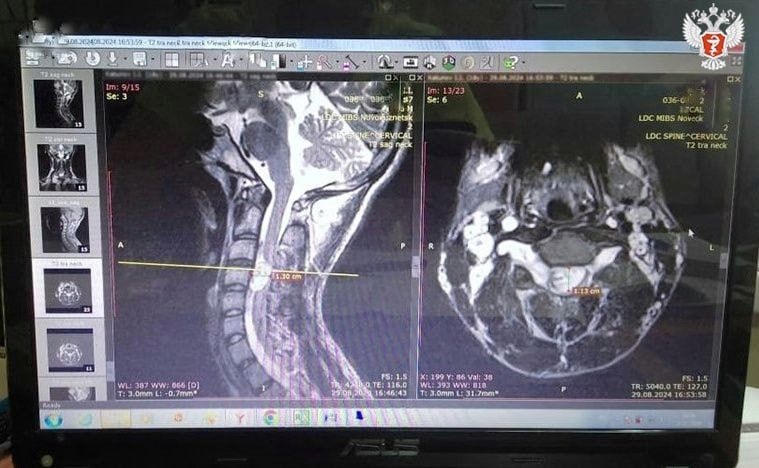 Новокузнецкие нейрохирурги спасли молодого пациента с редким заболеванием