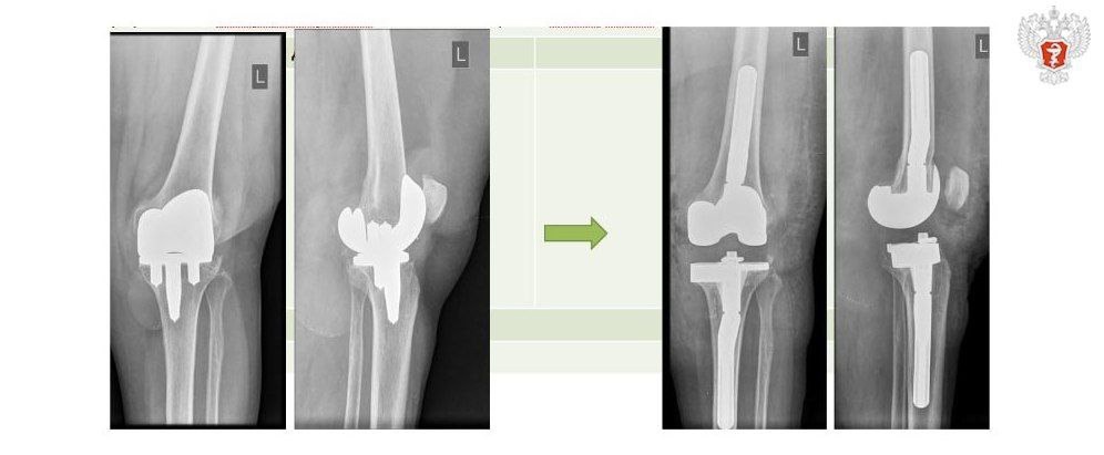 Врачи НМИЦ травматологии и ортопедии имени Г.А. Илизарова Минздрава России провели сложнейшие операции на суставах
