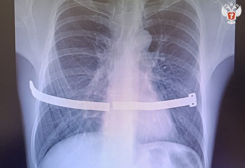 Жителю Сургута удалили обломки металлической пластины, которую он носил в груди 17 лет вместо положенных двух
