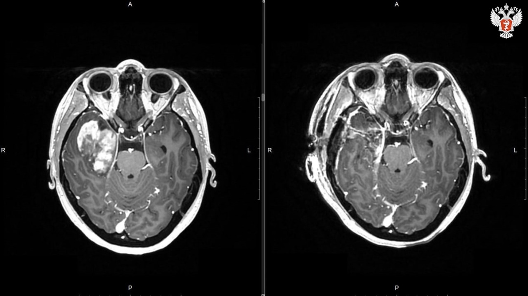 «Я всё время ощущала запах стирального порошка»: новосибирские нейрохирурги удалили опухоль из головного мозга молодой пациентки