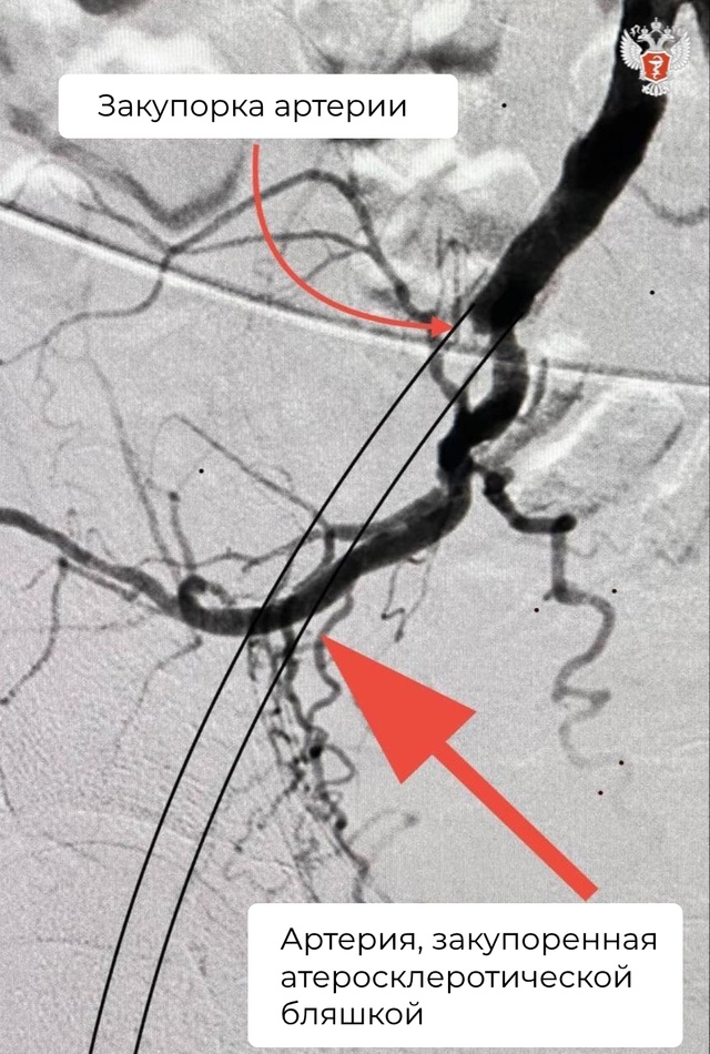 Омские врачи избавили пациента от привычной боли при ходьбе