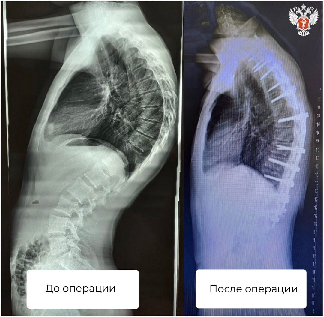 Воронежские врачи исправили сложное искривление позвоночника подростку, который страдал от сильных болей