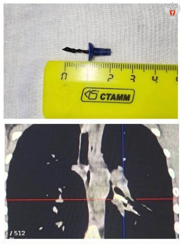 Воронежские врачи помогли девочке, которая около года ходила с канцелярской кнопкой в легких