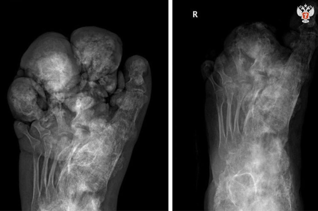 Хирурги федеральных центров Минздрава России помогли молодому пациенту — пальцы его стопы были увеличены в несколько раз из-за редкого заболевания