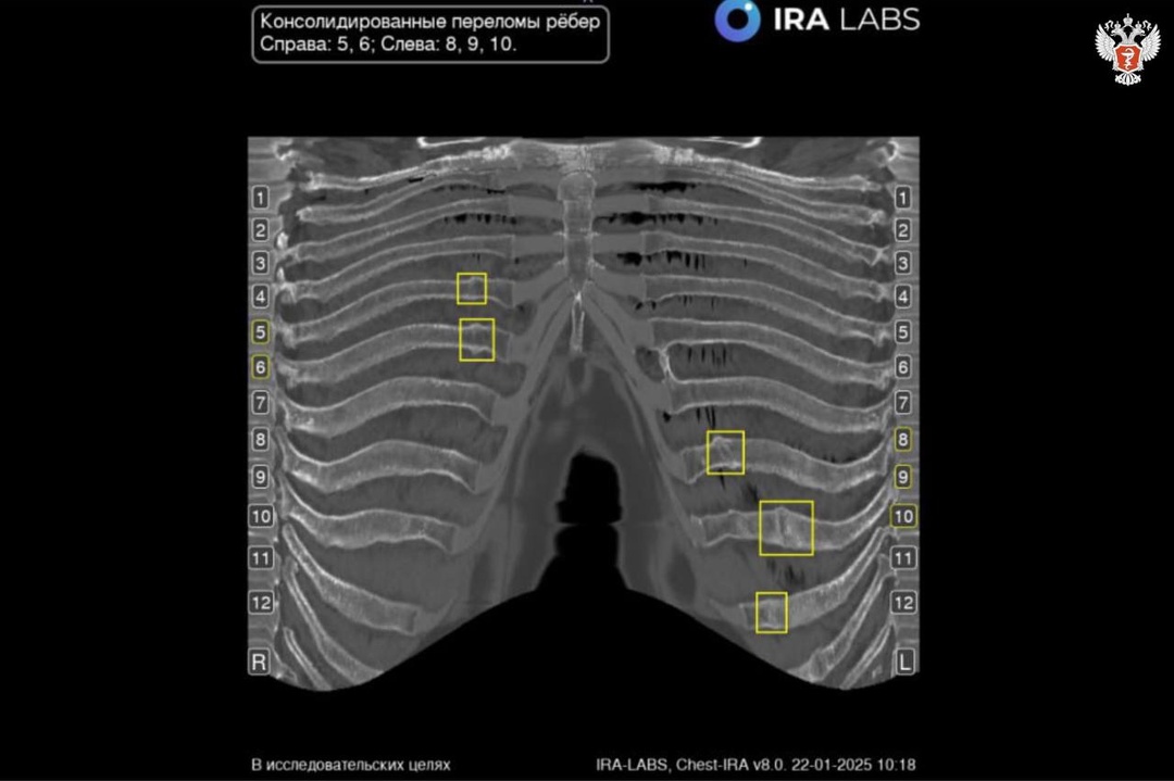 В медучреждениях Калмыкии внедряются сервисы с ИИ для расшифровки исследований