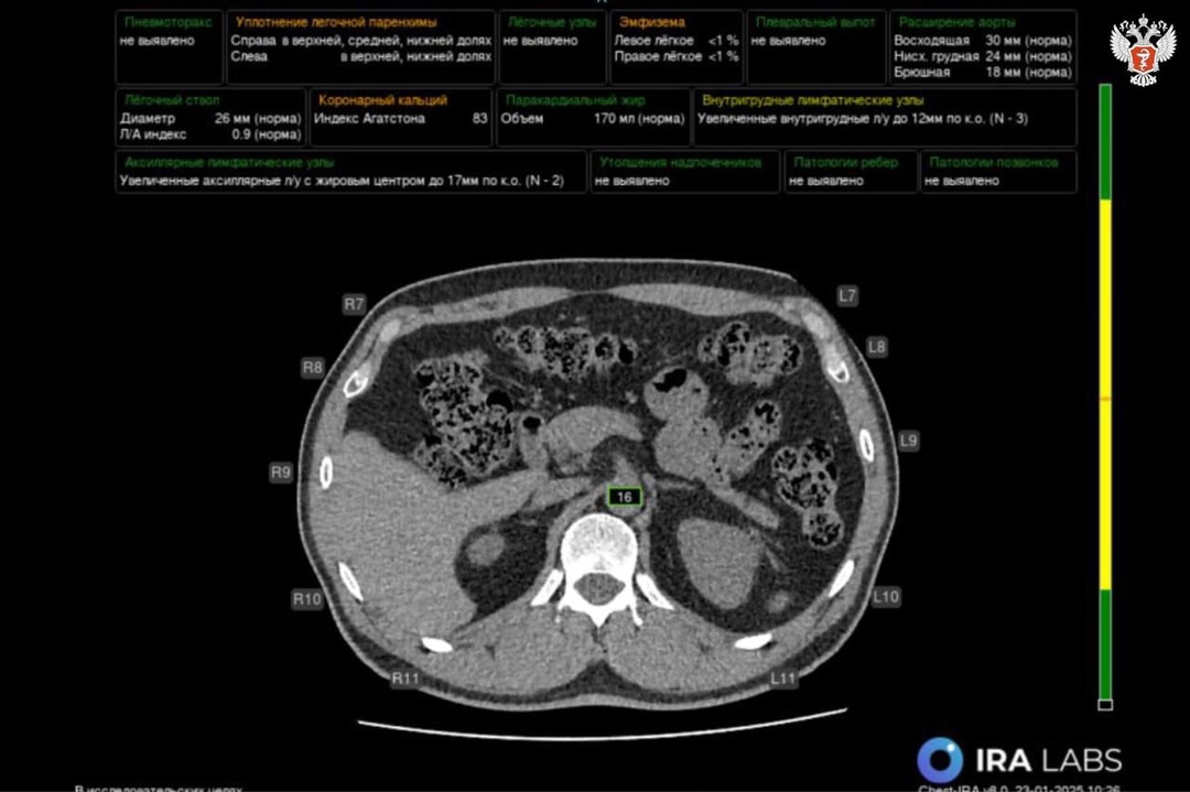 В медучреждениях Калмыкии внедряются сервисы с ИИ для расшифровки исследований
