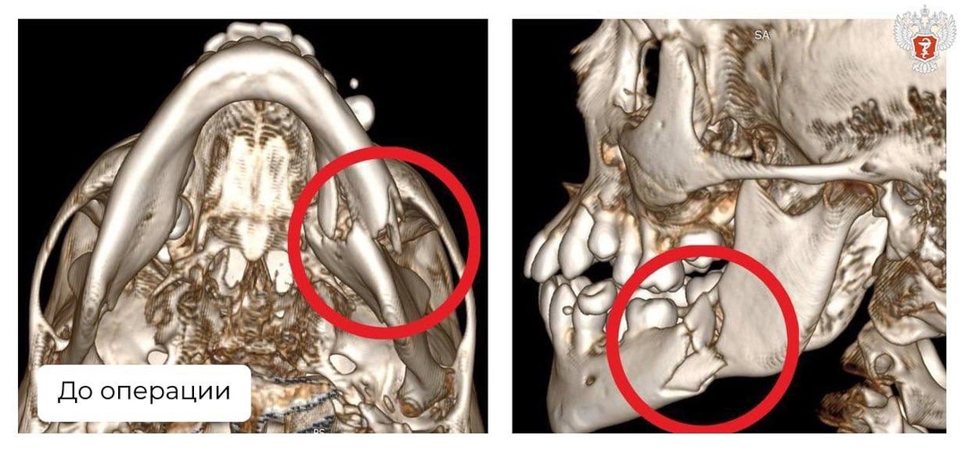 Подмосковные врачи собрали по частям челюсть 9-летнего мальчика после ДТП