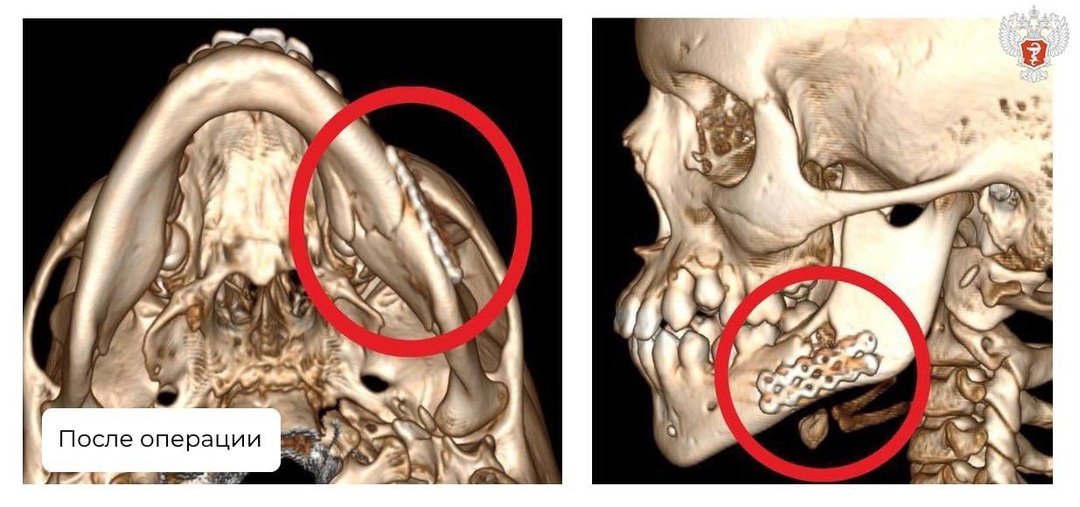 Подмосковные врачи собрали по частям челюсть 9-летнего мальчика после ДТП