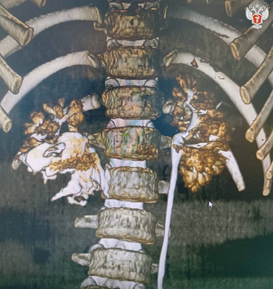 Воронежские врачи спасли 13-летнего мальчика с разрывом почки и сохранили орган