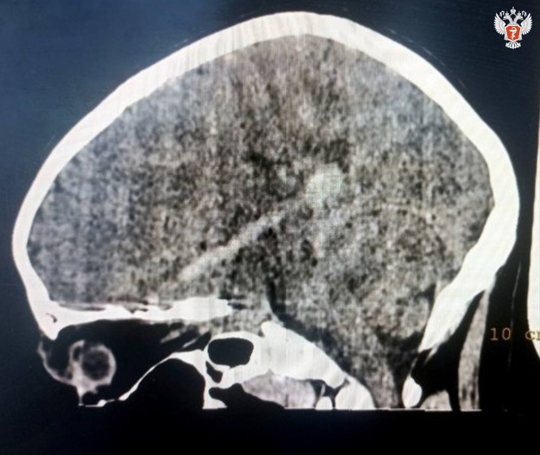 Кировские врачи спасли 9-летнего пациента, проткнувшего глазницу шампуром