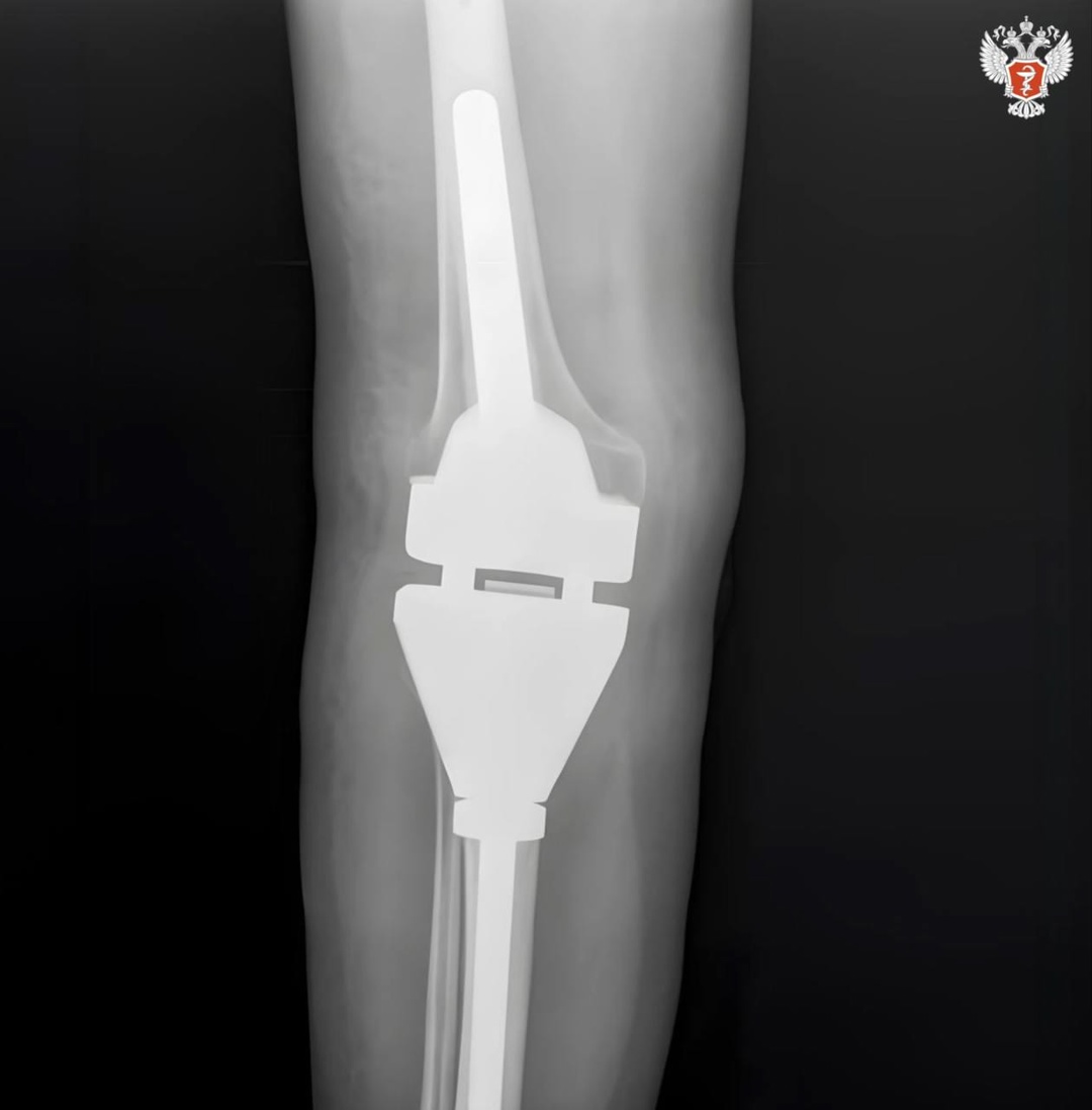 В Самаре женщине установили нераздвижной эндопротез коленного сустава, произведенный в СамГМУ Минздрава России
