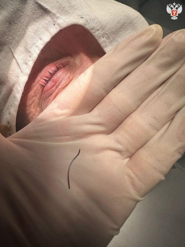 Подмосковные офтальмологи спасли зрение пациенту, которому в глаз отлетела проволока