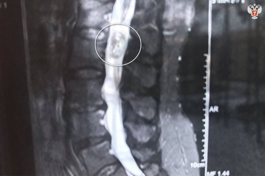 Воронежские врачи спасли пациентку с опухолью спинного мозга