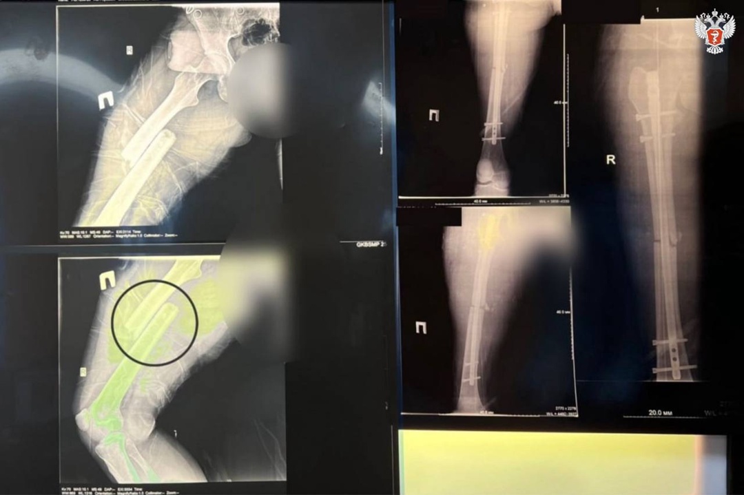 Волгоградские врачи спасли пациентку с серьезными травмами опорно-двигательного аппарата после ДТП