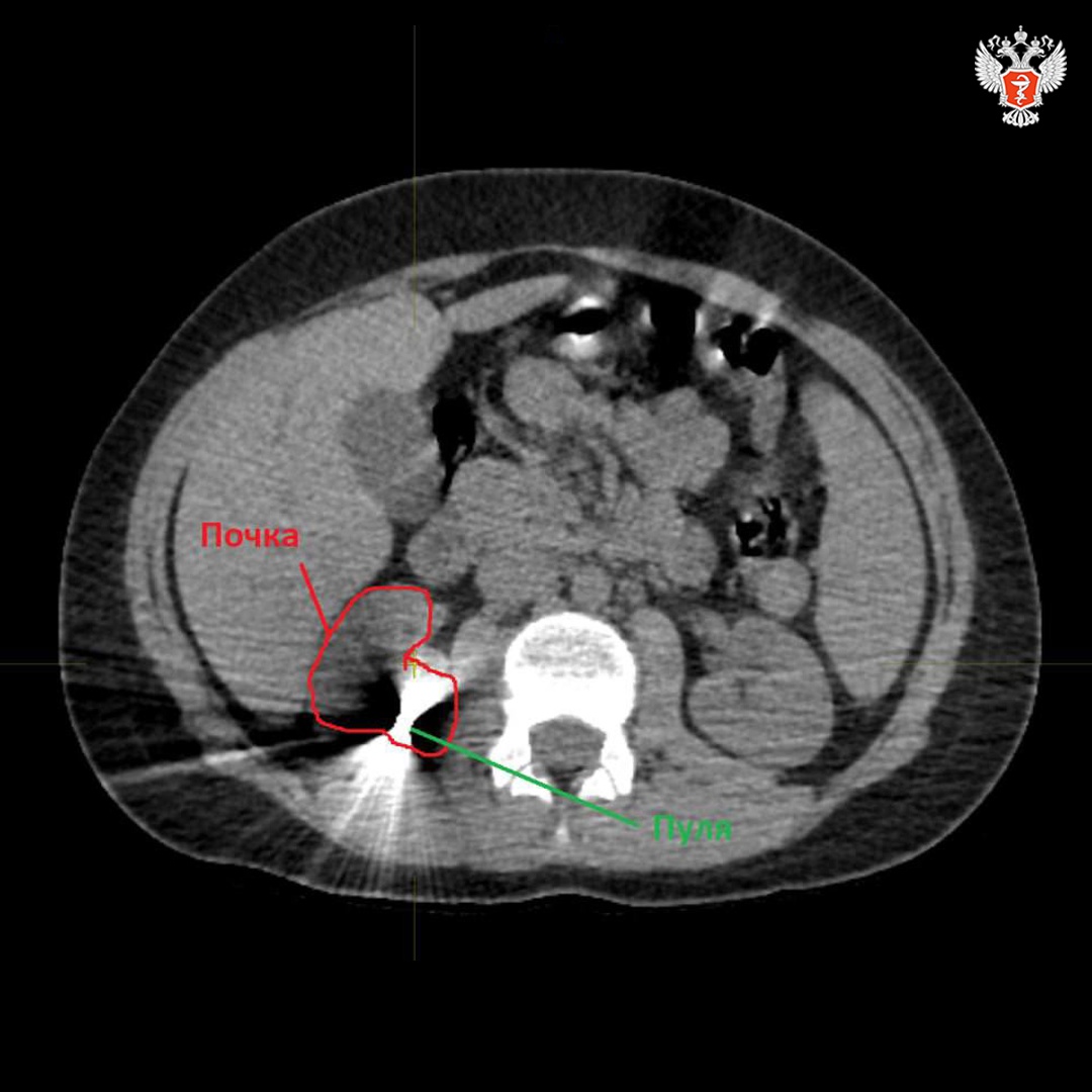 В Новгородской области врачи спасли подростка после ранения из пневматической винтовки