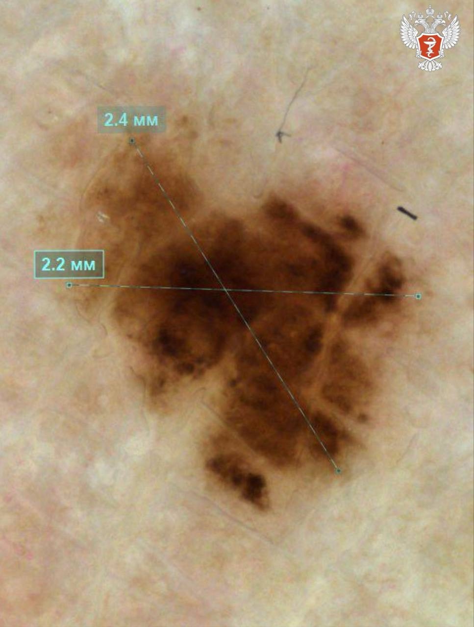 Врачи Липецкой области вовремя обнаружили микроскопическую меланому у молодой девушки