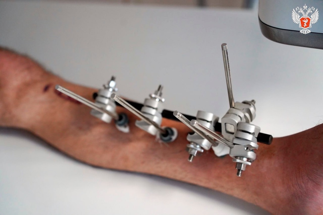 Врачи Свердловской области спасли ногу мужчине с помощью новой технологии