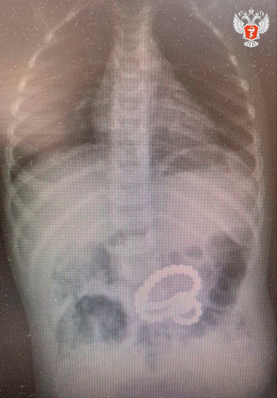 Воронежские врачи спасли ребенка, который проглотил 48 магнитов