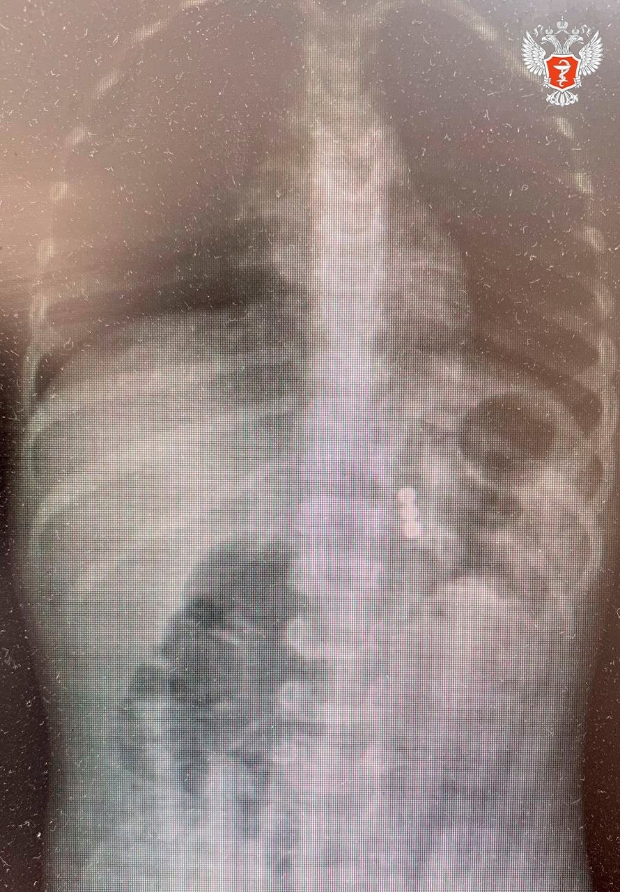 Воронежские врачи спасли ребенка, который проглотил 48 магнитов