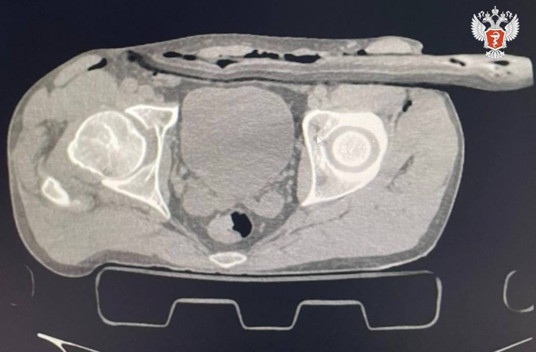Подмосковные врачи спасли мужчину, упавшего на ветку с крыши дома