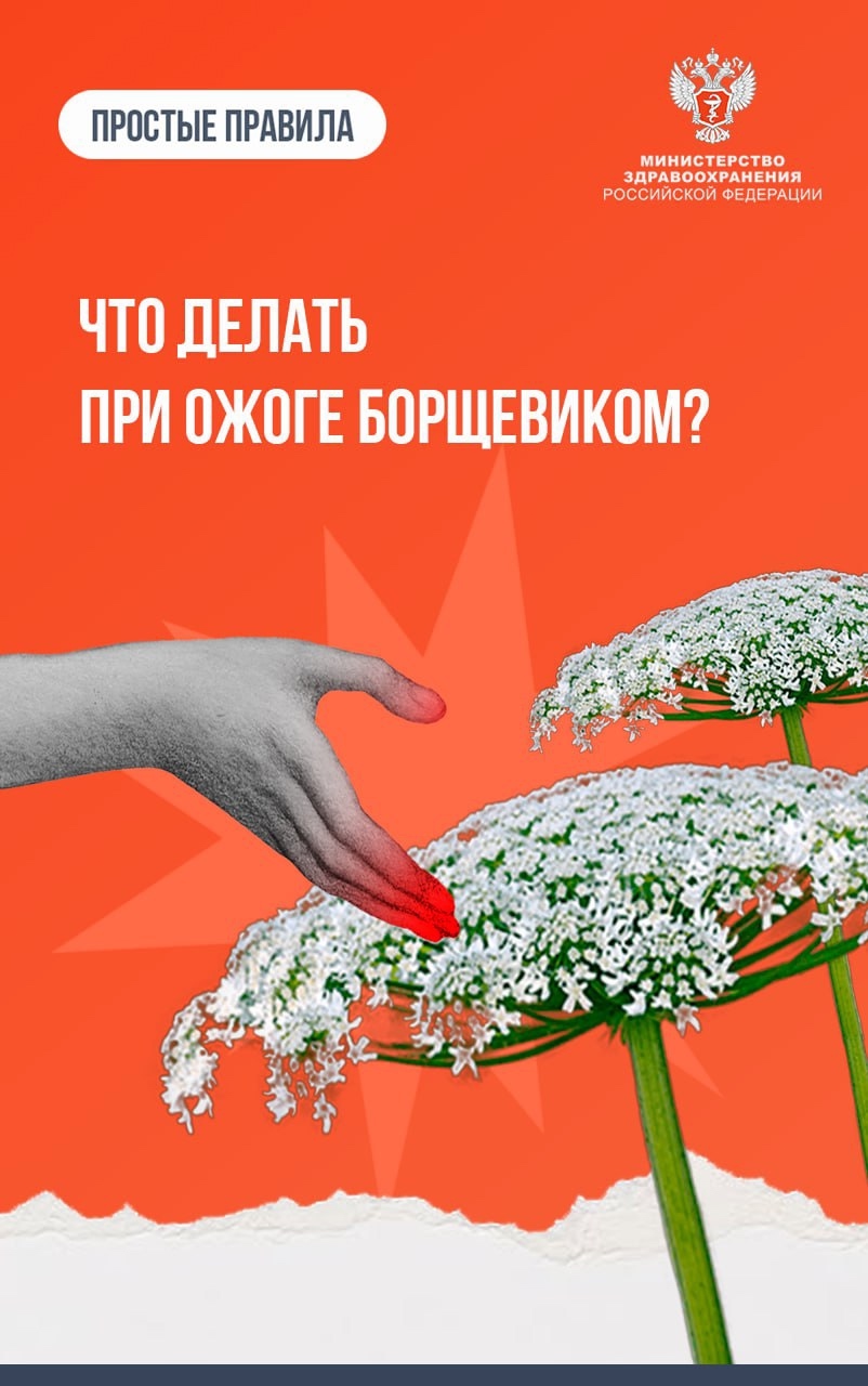#ПростыеПравила: Что делать при ожоге борщевиком