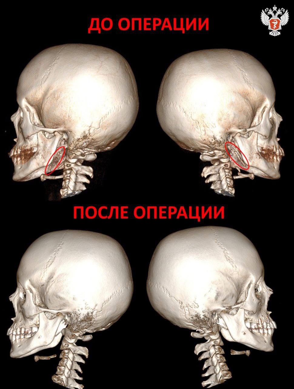 Хирурги Российской детской клинической больницы Минздрава России провели операцию ребенку с редким генетическим синдромом