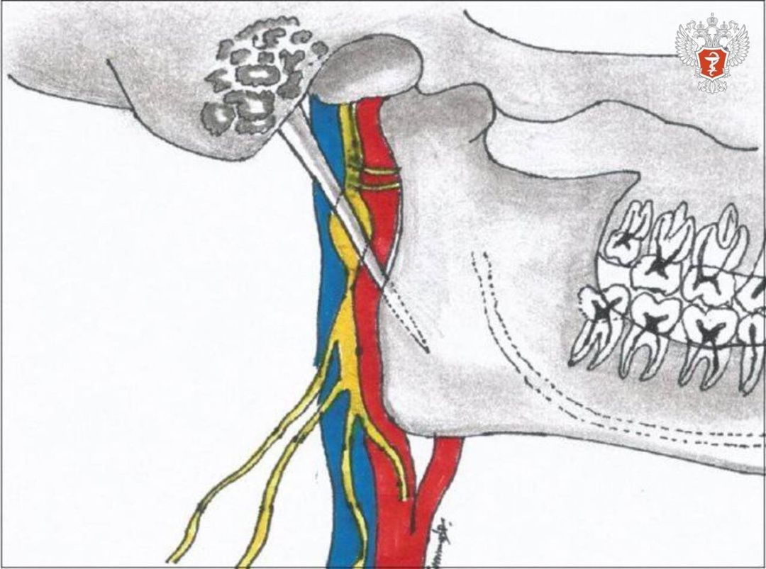Хирурги Российской детской клинической больницы Минздрава России провели операцию ребенку с редким генетическим синдромом