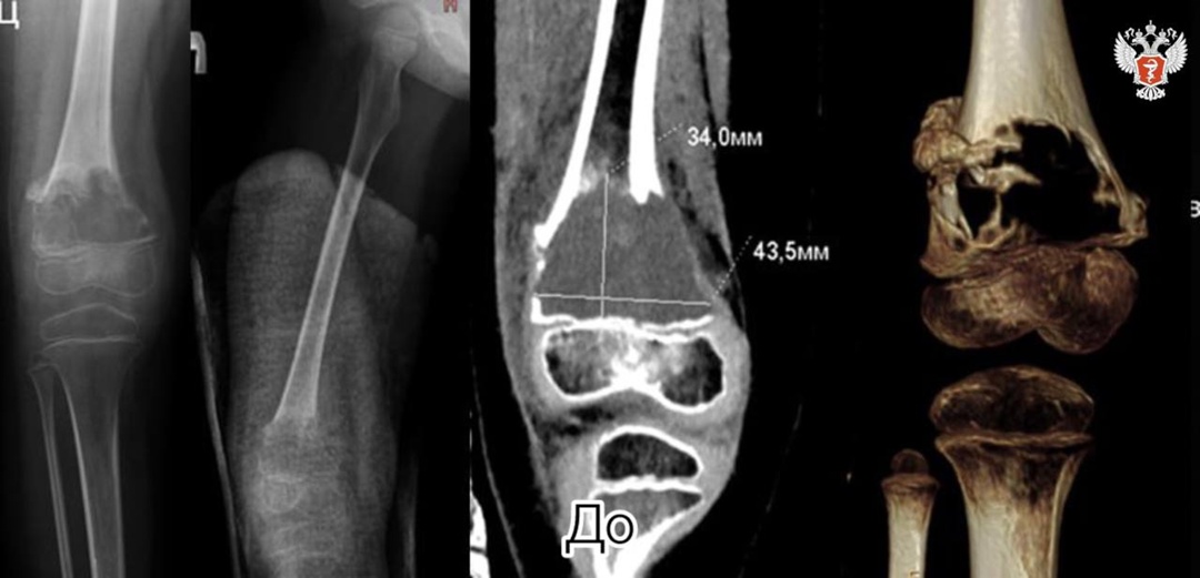 Врачи НМИЦ травматологии и ортопедии им. ак. Г.А. Илизарова Минздрава России спасли девочку с редкой ортопедической патологией