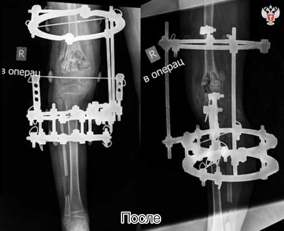 Врачи НМИЦ травматологии и ортопедии им. ак. Г.А. Илизарова Минздрава России спасли девочку с редкой ортопедической патологией