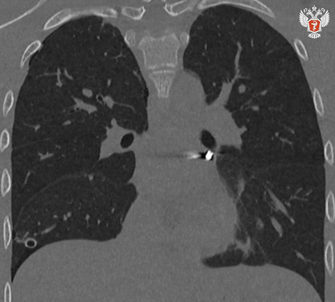 Подмосковные врачи спасли подростка с пулей в сердце