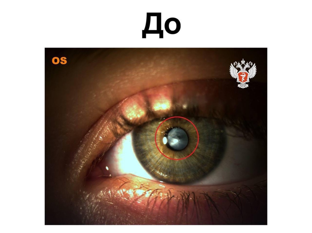 Подмосковные врачи вернули зрение подростку, ослепшему из-за сахарного диабета