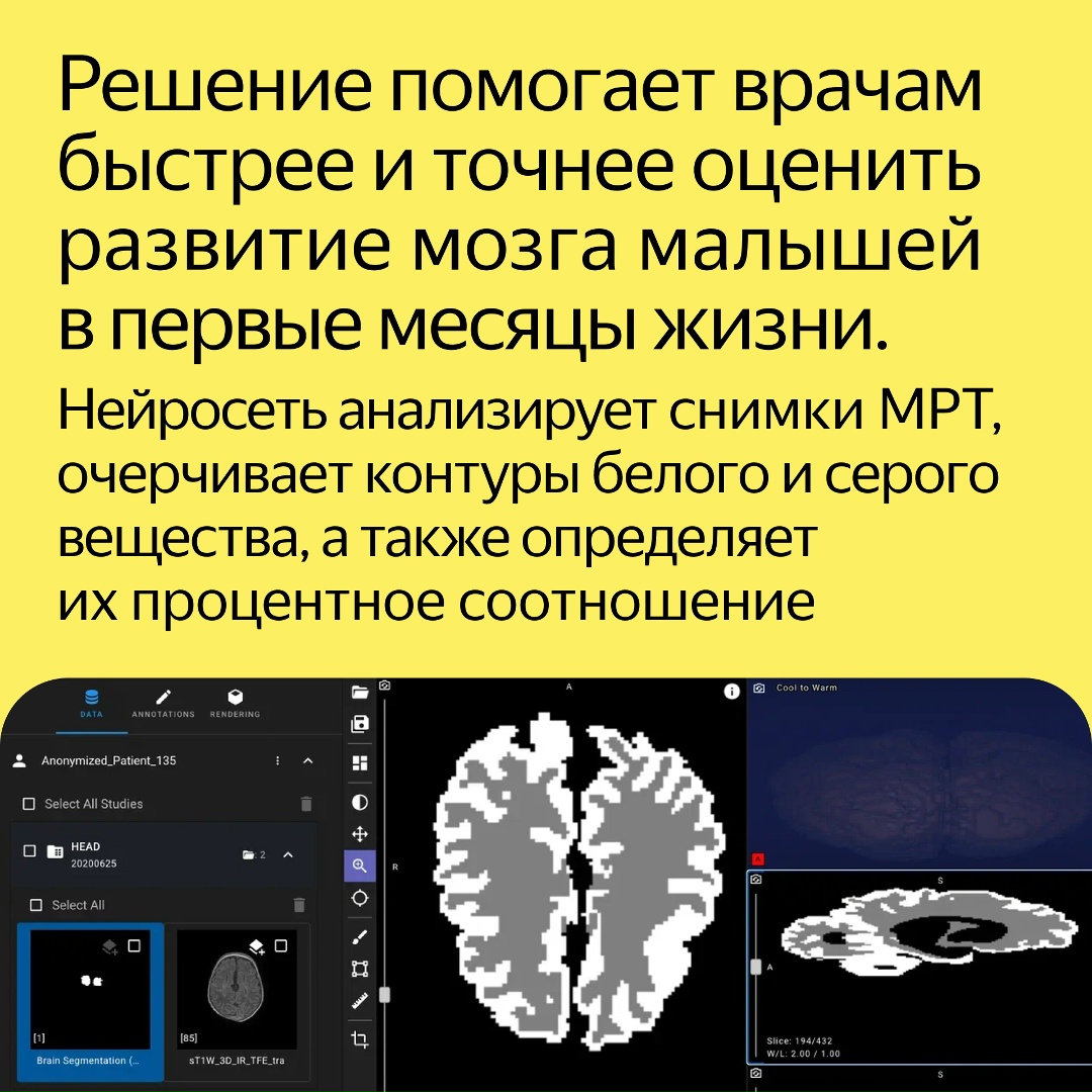 Это первое ИИ-решение для ранней диагностики ДЦП и других заболеваний центральной нервной системы у новорождённых