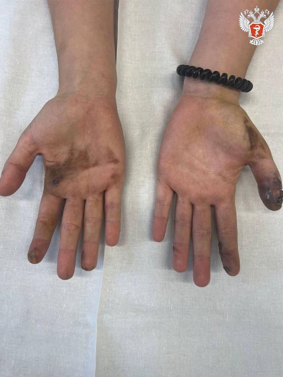 Подмосковные врачи спасли пациентку, у которой в руках взорвался телефон