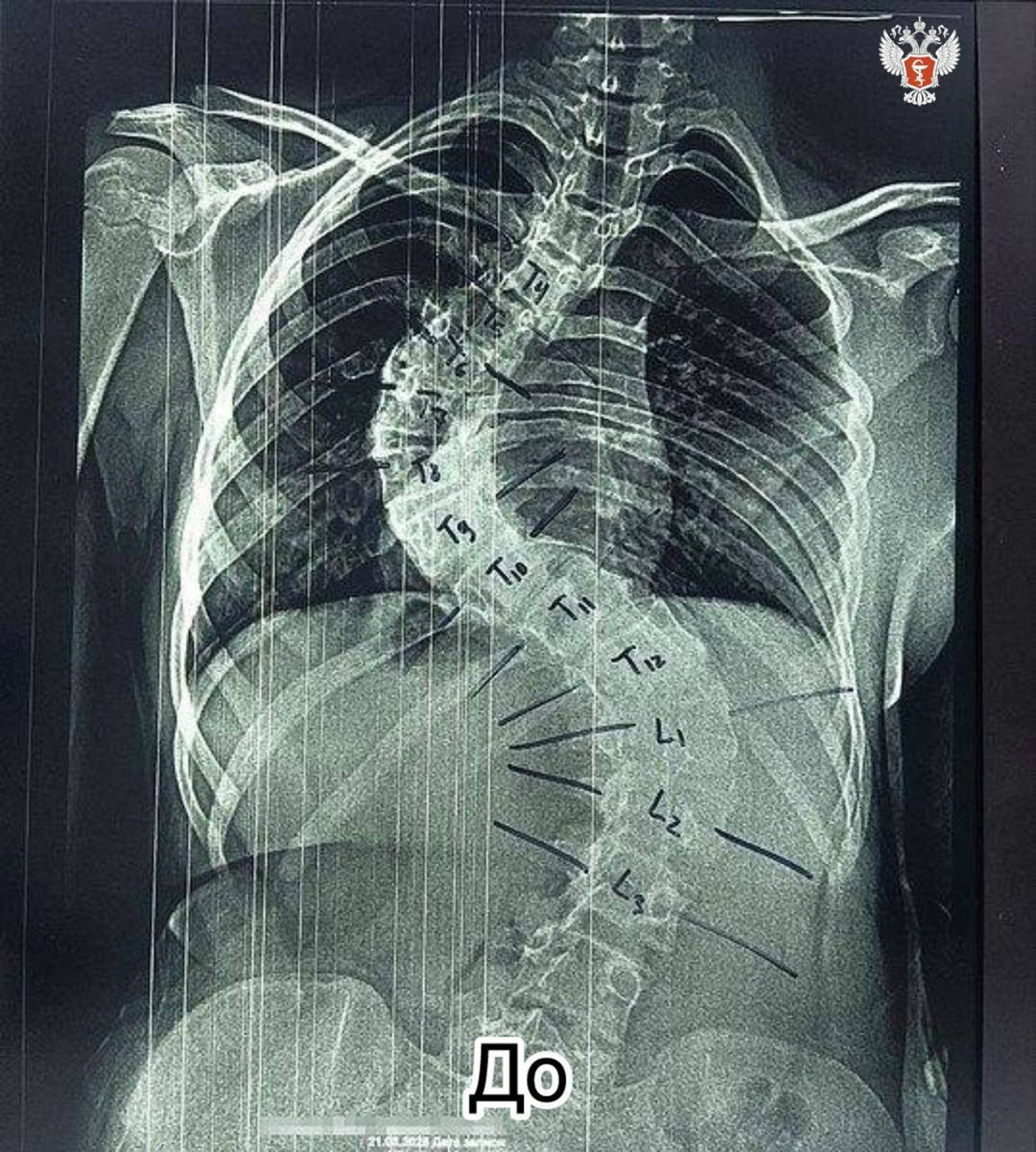 Кировские врачи спасли подростка из Запорожской области с сильной деформацией позвоночника