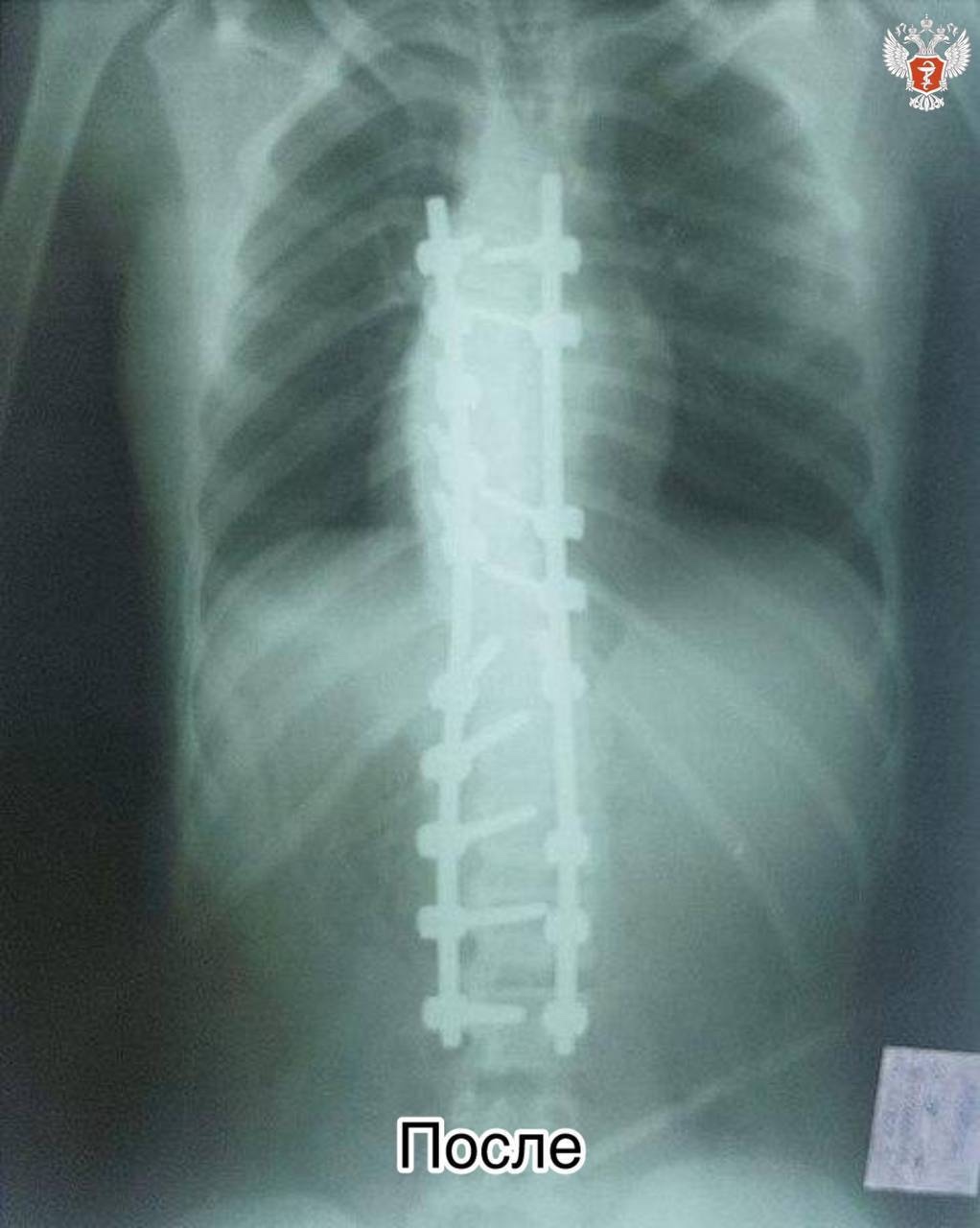 Кировские врачи спасли подростка из Запорожской области с сильной деформацией позвоночника