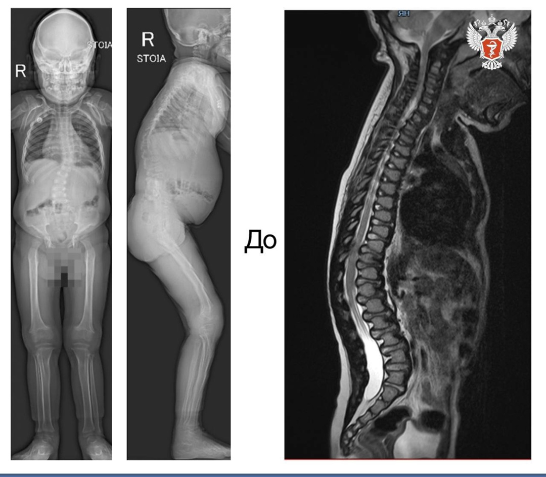 Врачи НМИЦ травматологии и ортопедии им. ак. Г.А. Илизарова Минздрава России помогли девочке с искривлением позвоночника