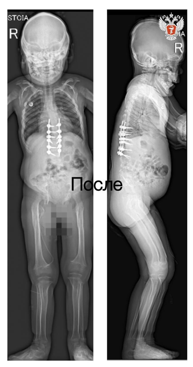 Врачи НМИЦ травматологии и ортопедии им. ак. Г.А. Илизарова Минздрава России помогли девочке с искривлением позвоночника