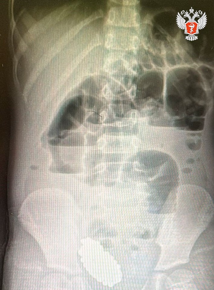 Волгоградские врачи спасли ребенка, который проглотил 134 магнитных шарика